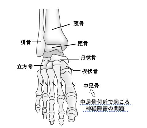 モートン病　関連図