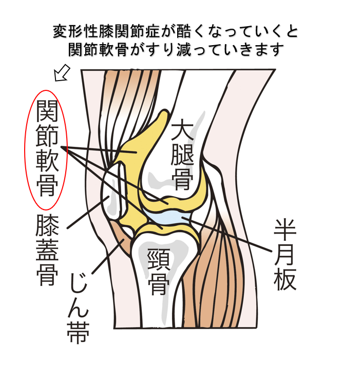 変形性膝関節症