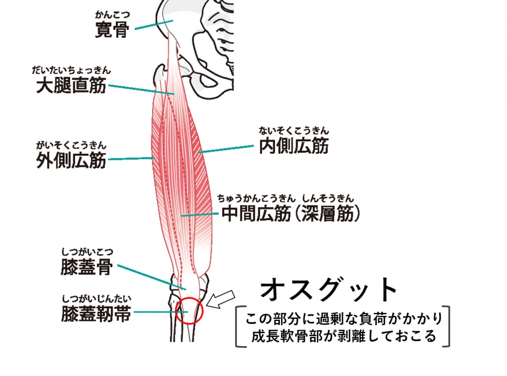オスグット 図